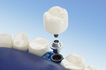 Dental Implant Dental Implant treatment turkey